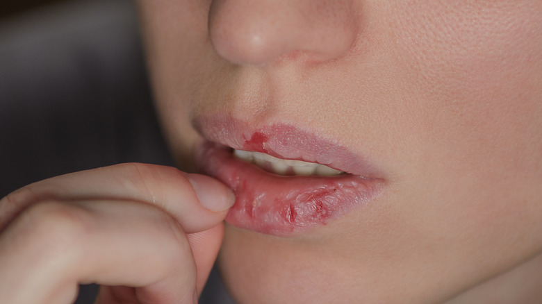 woman picking at lips